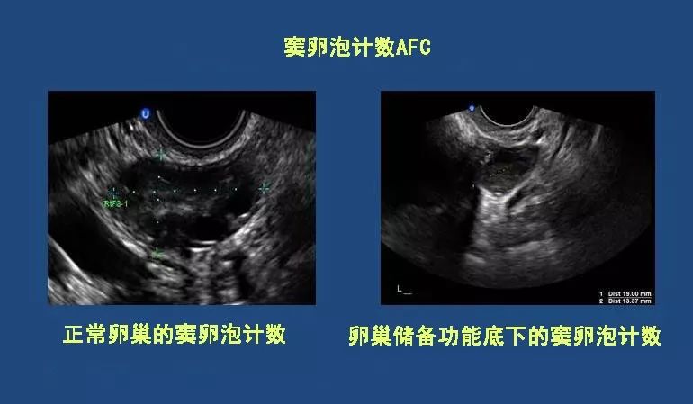 窦卵泡计数afc预测你卵巢储备功能的基本盘