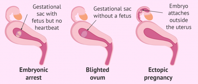 Miscarriage types according to gestational sac