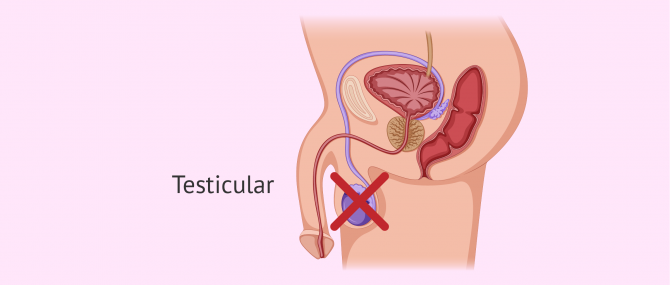 Azoospermia due to testicular causes