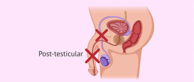 Post-testicular causes of azoospermia