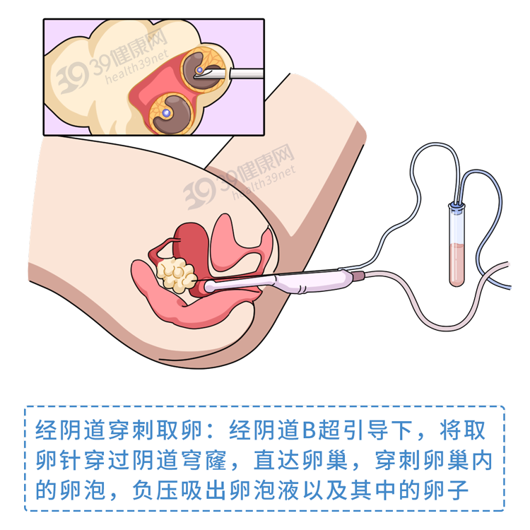 做试管婴儿有多“遭罪”?一篇漫画解释整个过程,看完泪目了