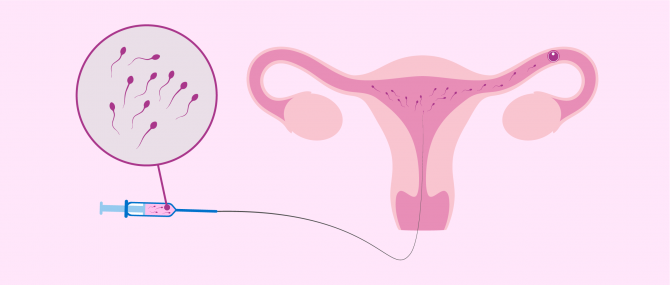 how does intrauterine insemination (iui) take place?