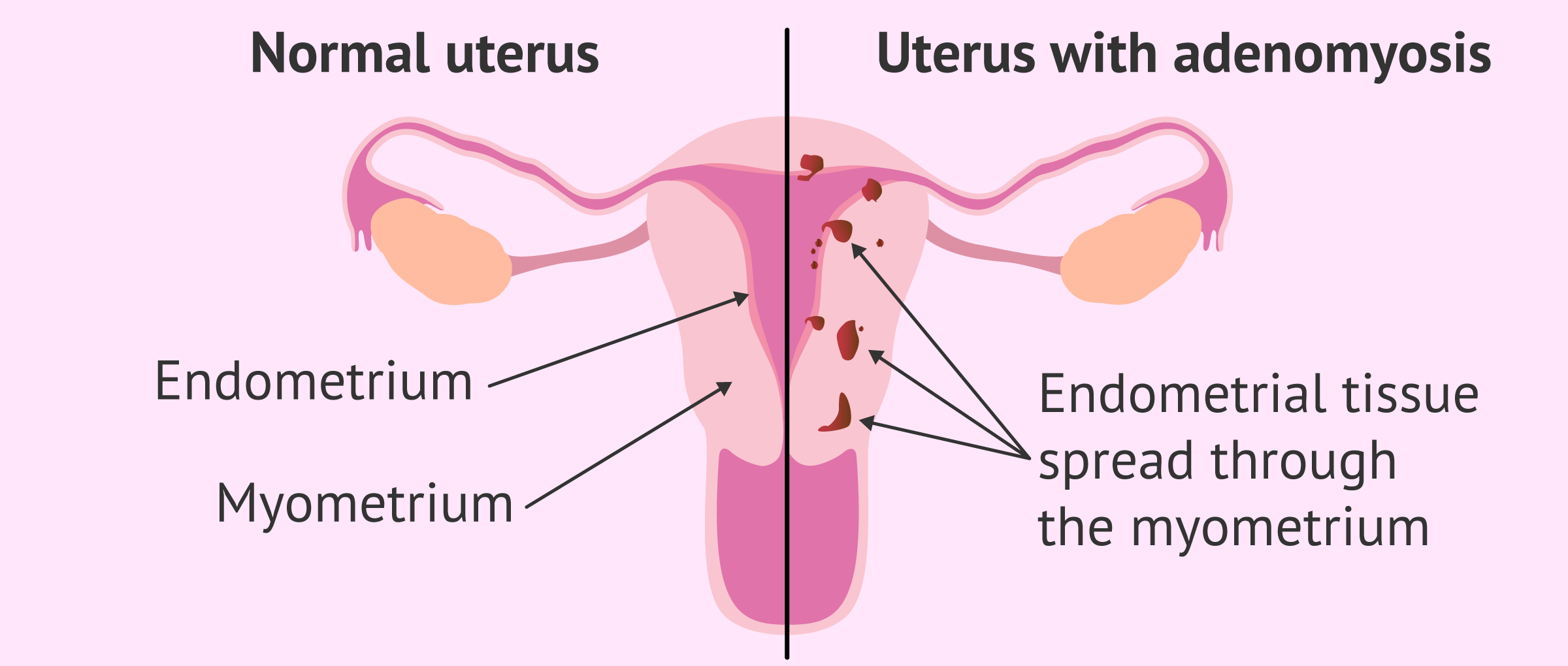 comparation between healthy uterus and uterine adenomyosis