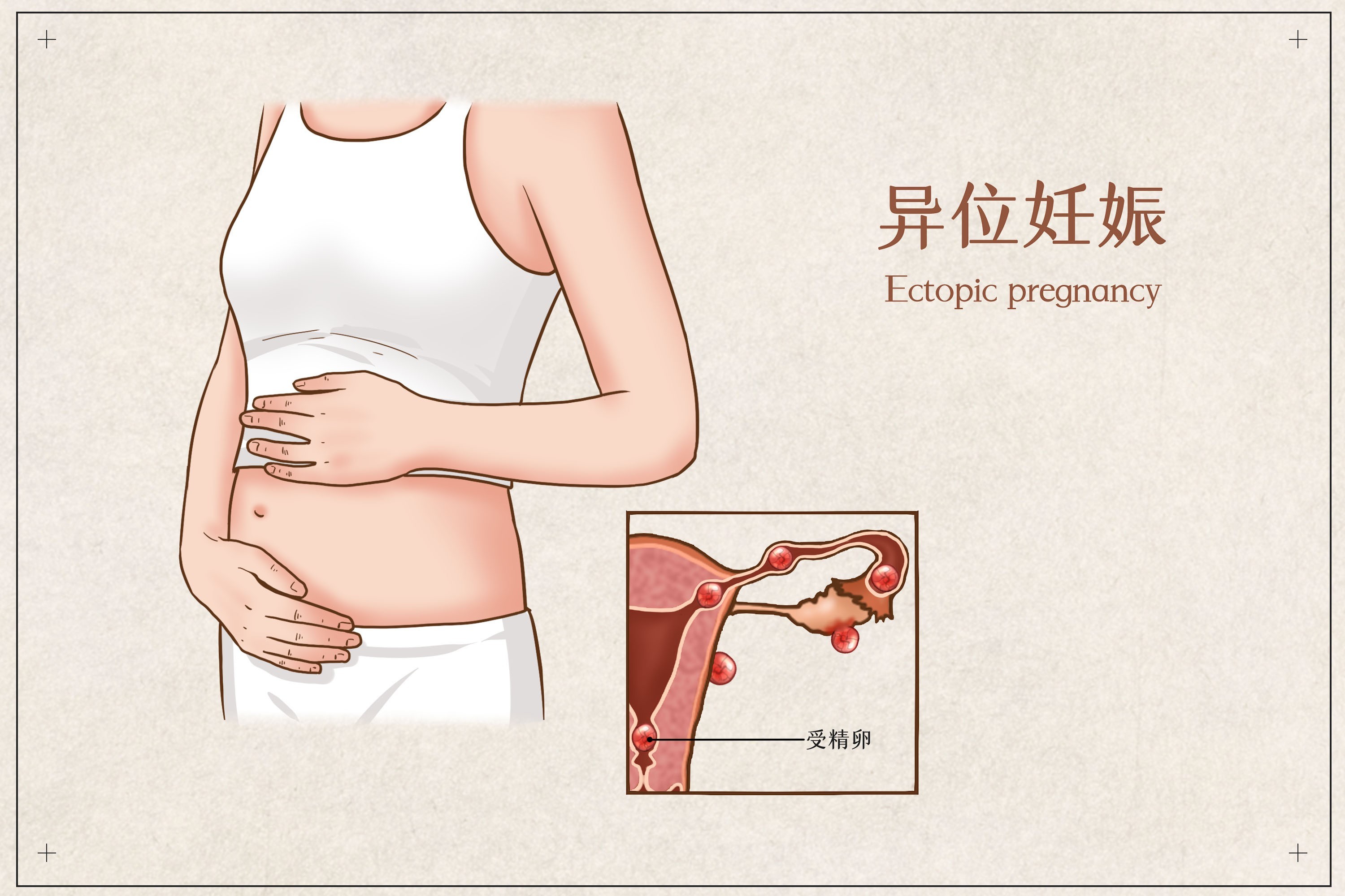 宫外孕图片 示意图图片